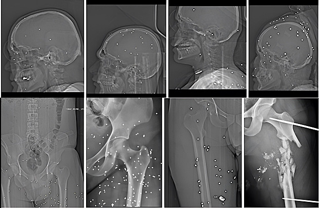 Rentgeny hrůzy. Íránská armáda cíleně střílí demonstrantům do očí a genitálií